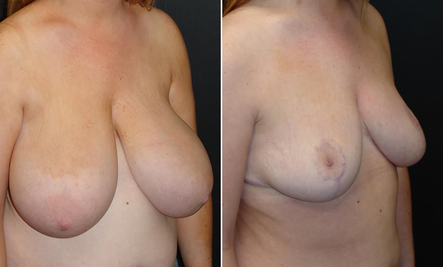 Before & After Breast Reduction Quarter Right View