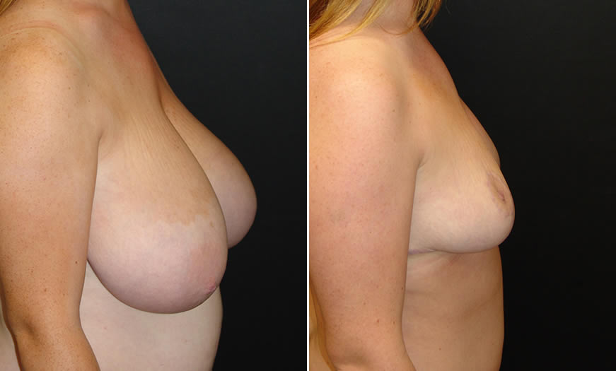 Before & After Breast Reduction Side Right