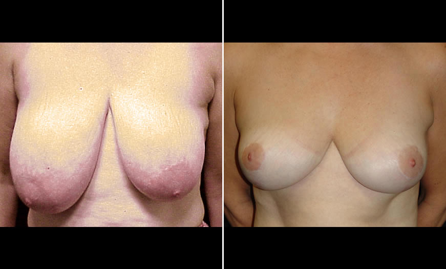 Before & After Breast Reduction Front View