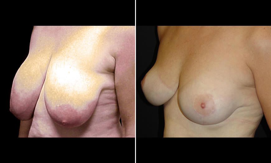 Before & After Breast Reduction Quarter Left View