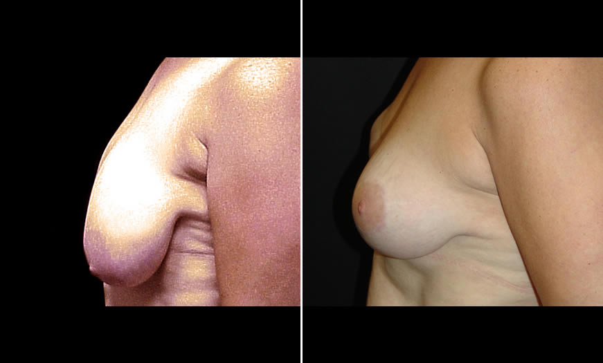 Before & After Breast Reduction Side Left