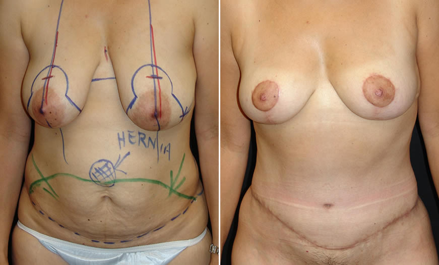 Before & After Breast Reduction Front View