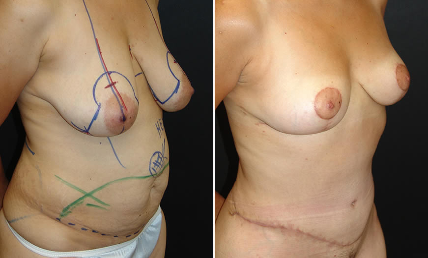 Before & After Breast Reduction Quarter Right View