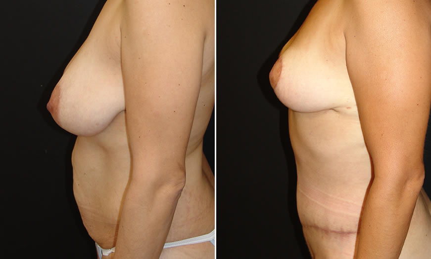 Before & After Breast Reduction Side Left