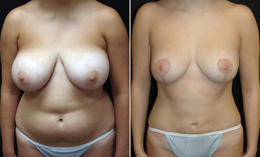 Before & After Breast Reduction Front View