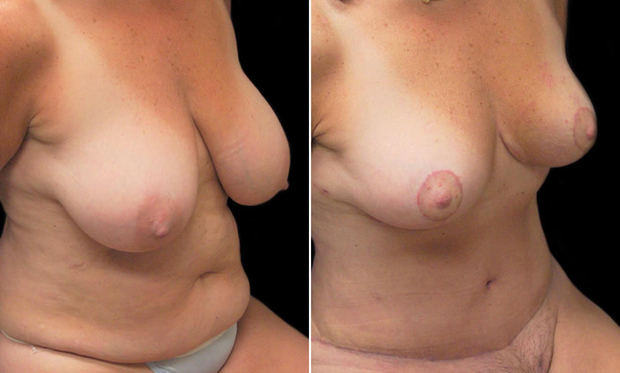 Before & After Breast Reduction Quarter Right View