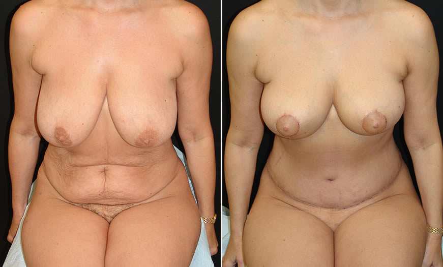 Before & After Breast Reduction Front View