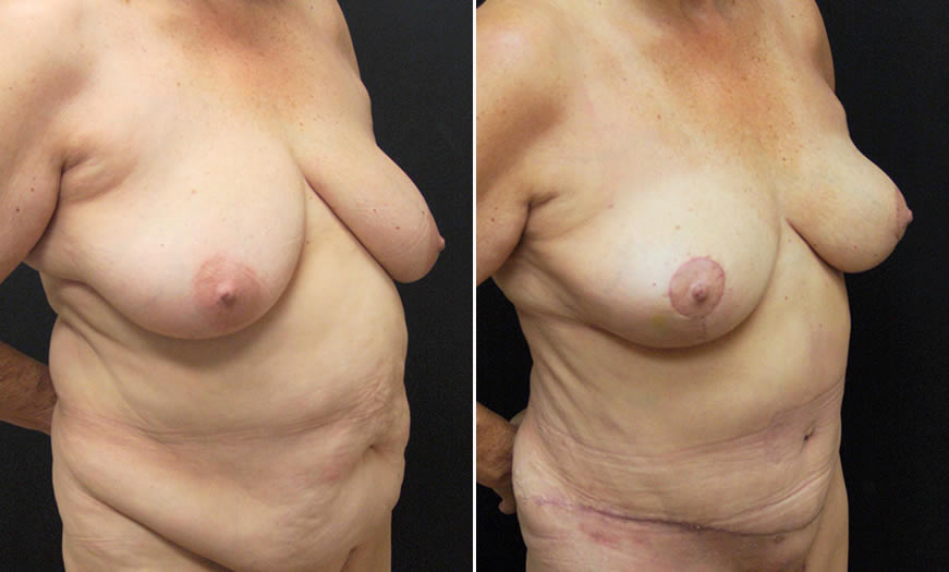 Before & After Breast Reduction Quarter Right View