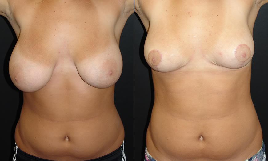 Before & After Breast Reduction Front View