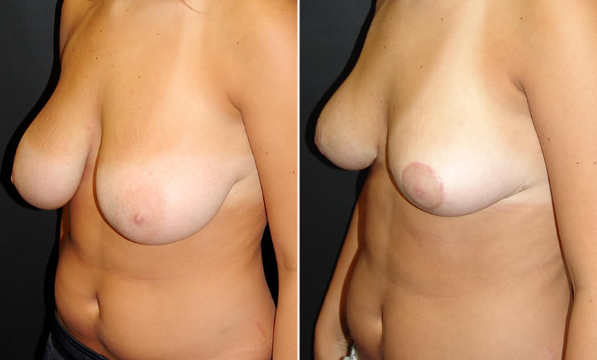 Before & After Breast Reduction Quarter Left View