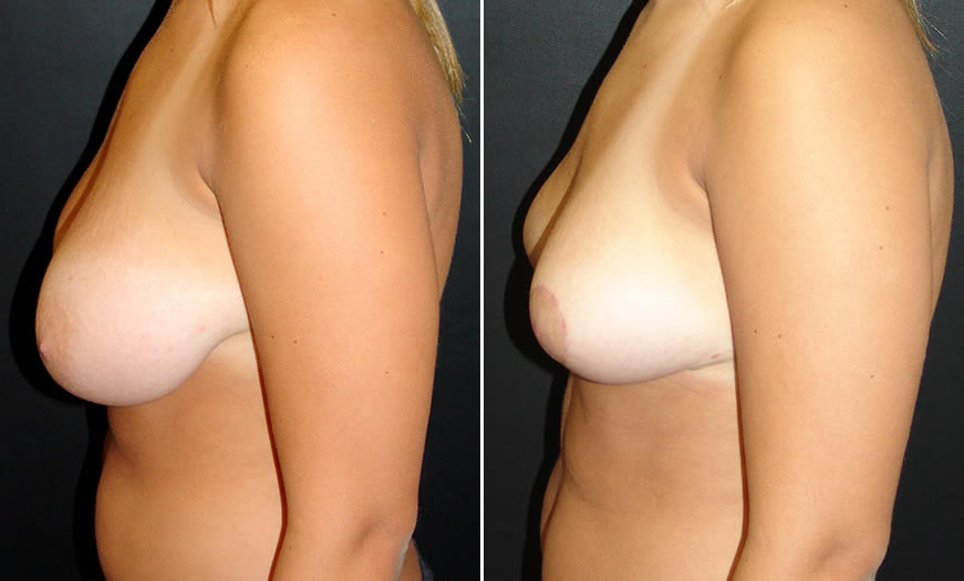 Before & After Breast Reduction Side Left