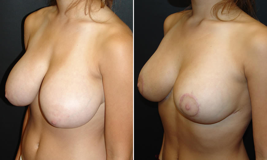 Before & After Breast Reduction Quarter Left View