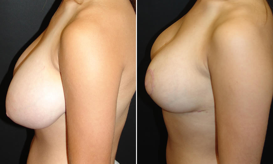 Before & After Breast Reduction Side Left