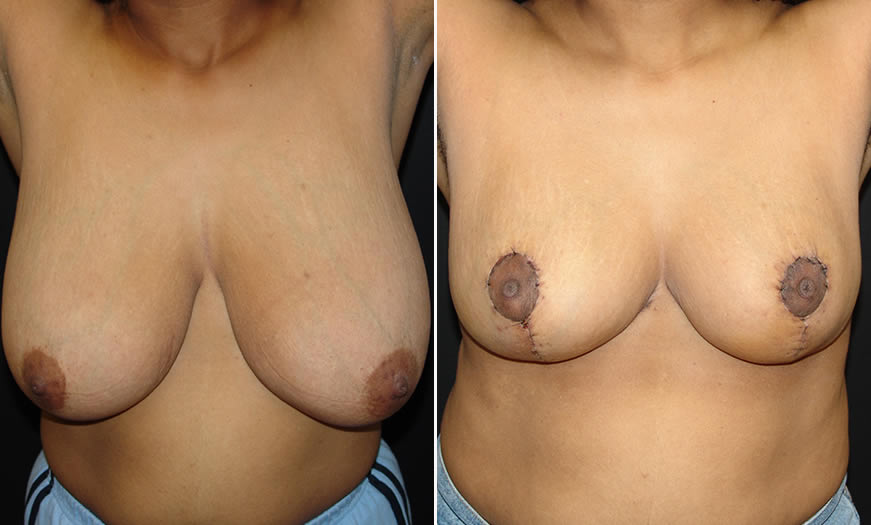 Before & After Breast Reduction Front View