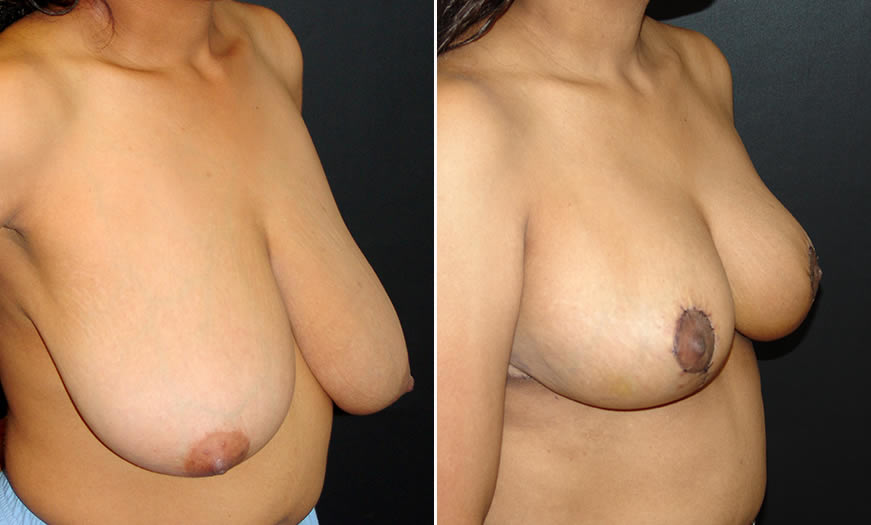Before & After Breast Reduction Quarter Right View
