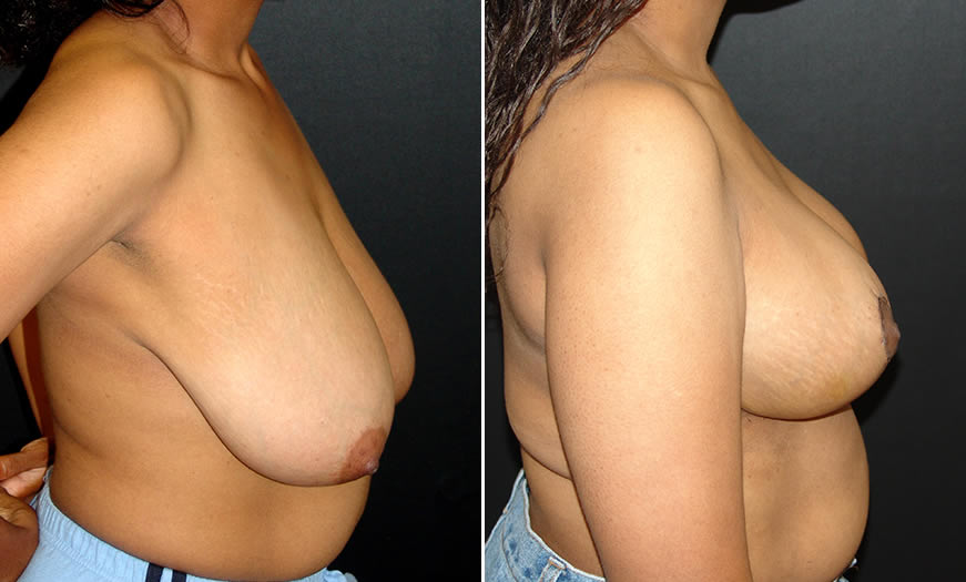 Before & After Breast Reduction Side Right