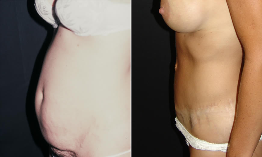 Before & After Core Abdominoplasty Side Left View 2