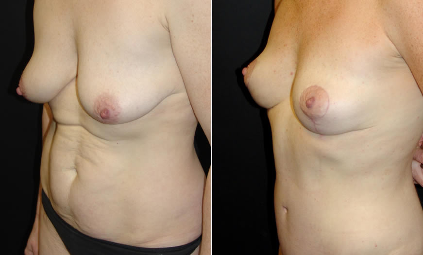 Before & After Core Abdominoplasty Quarter Left View