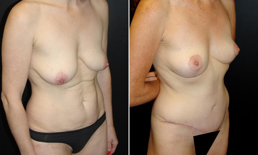 Before & After Core Abdominoplasty Quarter Right View