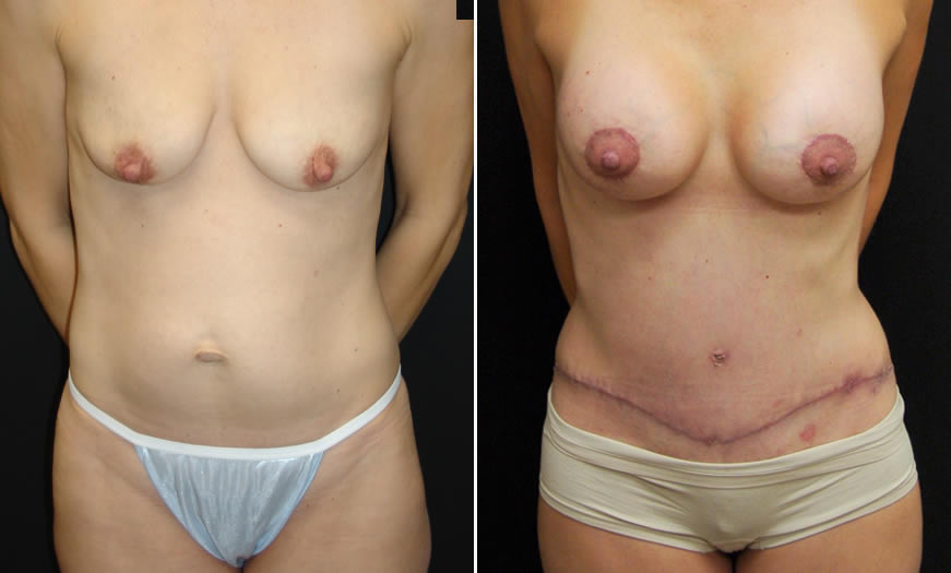 Before & After Core Abdominoplasty Front View