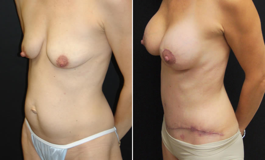 Before & After Core Abdominoplasty Quarter Left View