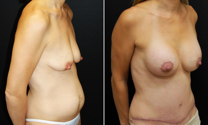 Before & After Core Abdominoplasty Quarter Right View