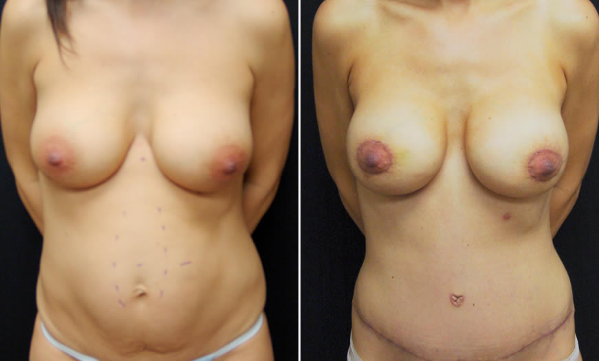 Before & After Core Abdominoplasty Front View