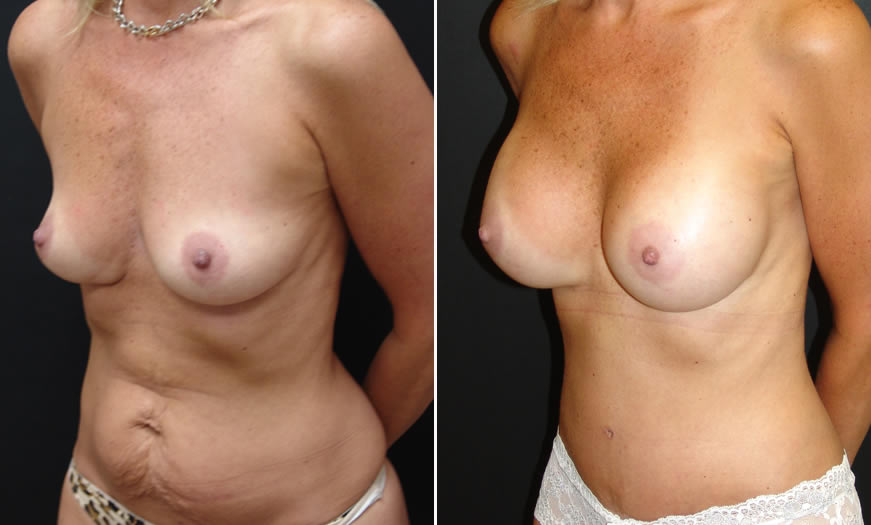 Before & After Tummy Tuck Quarter Left View