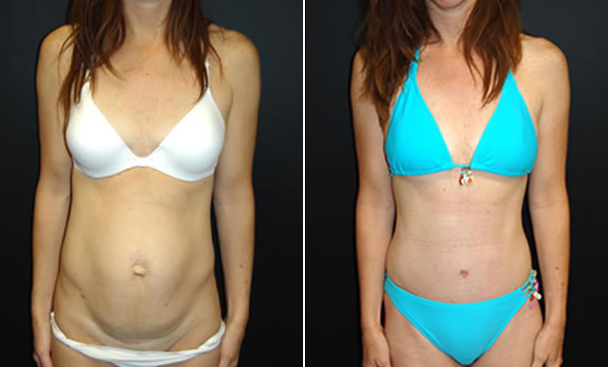 Before & After Tummy Tuck Front View