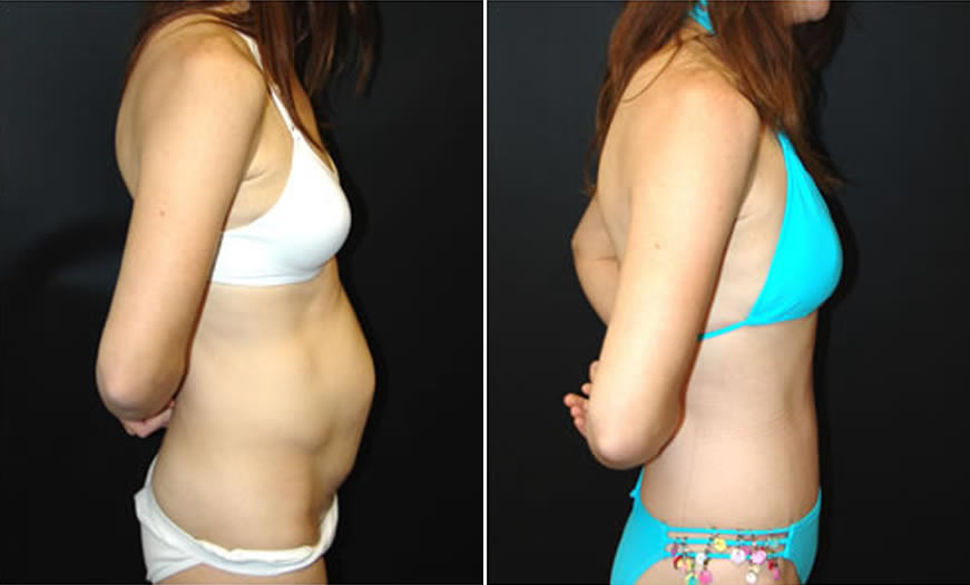 Before & After Tummy Tuck Side Right View