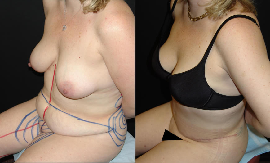 Before & After Tummy Tuck Quarter Left View