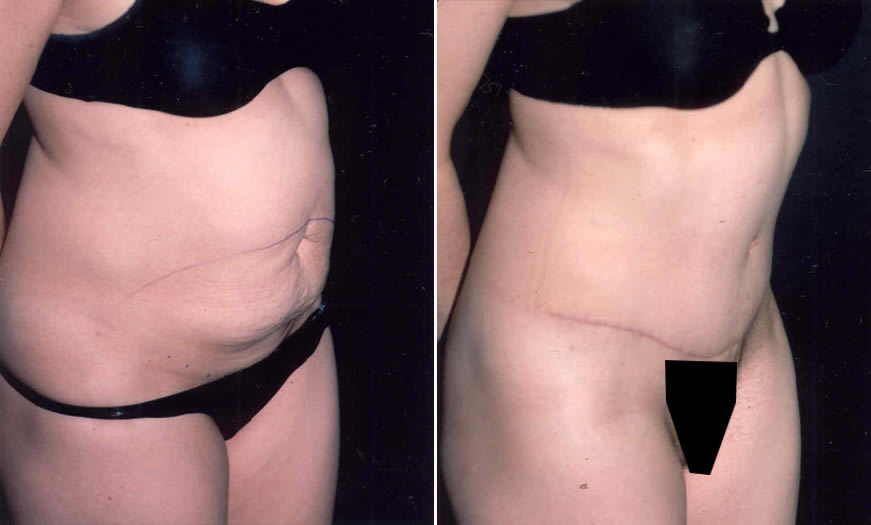 Before & After Tummy Tuck Quarter Right View