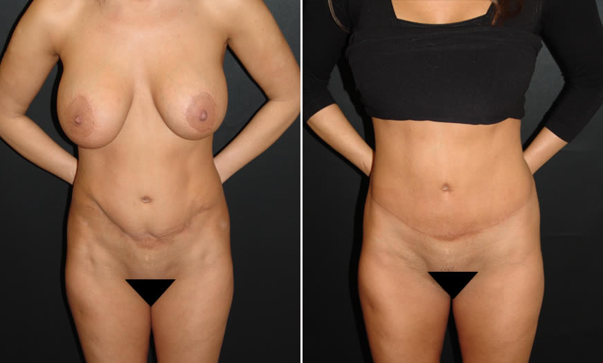 Before & After Tummy Tuck Front View