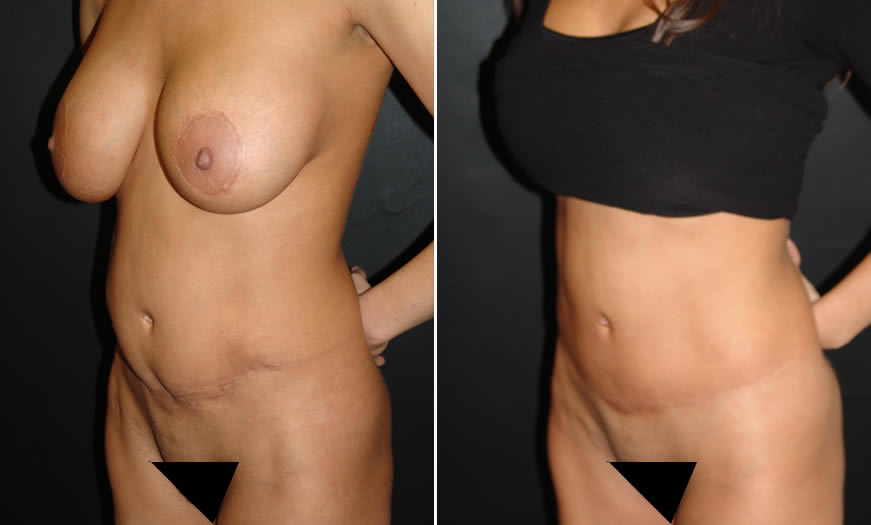 Before & After Tummy Tuck Quarter Left View