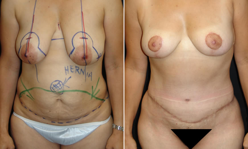 Before & After Tummy Tuck Front View