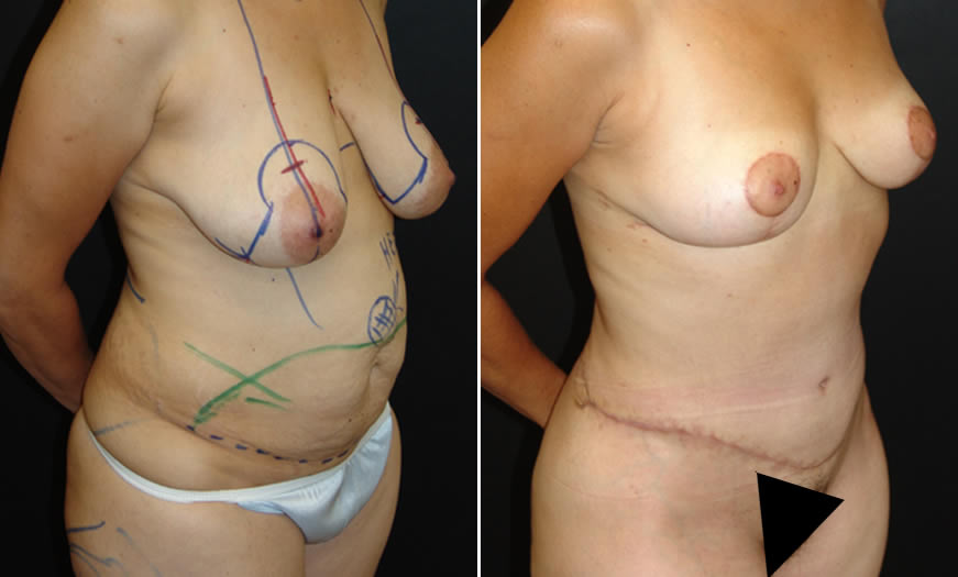 Before & After Tummy Tuck Quarter Right View