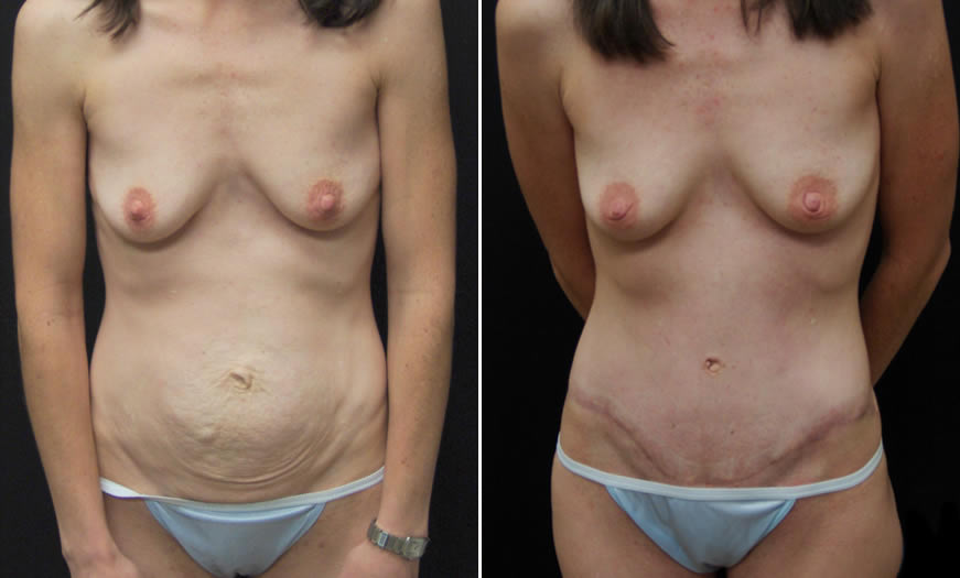 Before & After Tummy Tuck Front View