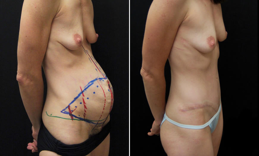 Before & After Tummy Tuck Quarter Right View