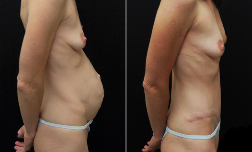 Before & After Tummy Tuck Side Right View