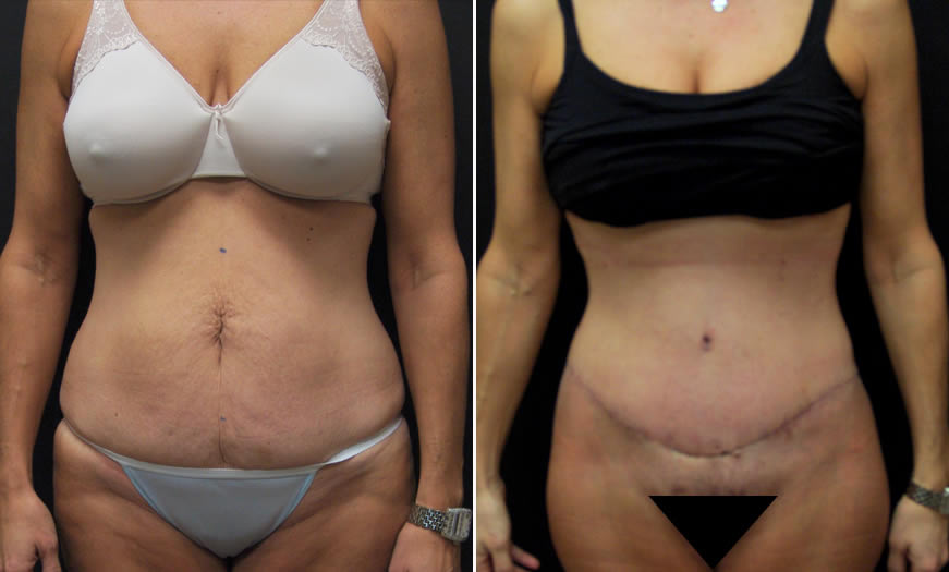 Before & After Tummy Tuck Front View
