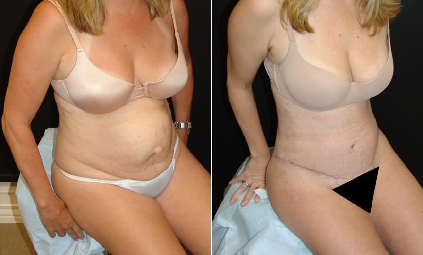 Before & After Tummy Tuck Quarter Right View