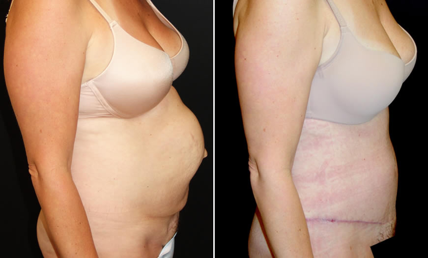 Before & After Tummy Tuck Side Right View