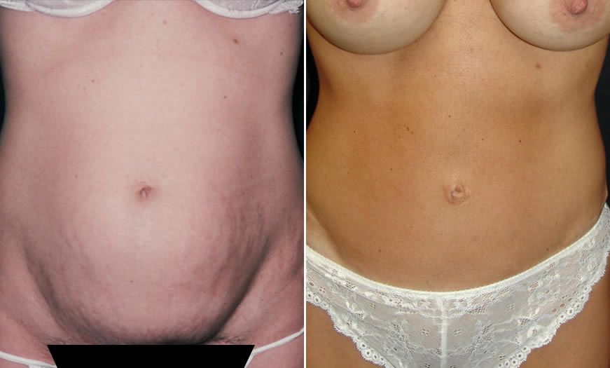 Before & After Tummy Tuck Front View