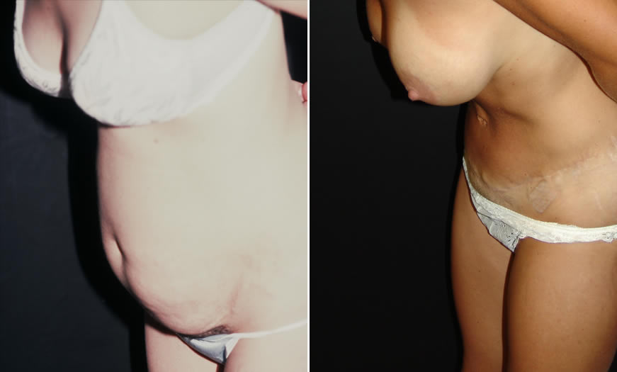 before & after Tummy Tuck Side Left Bent View