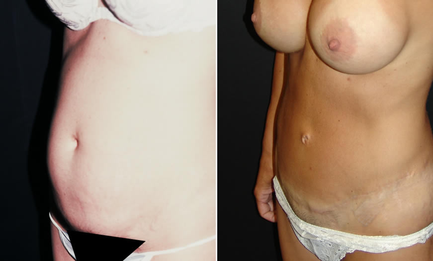 Before & After Tummy Tuck Quarter Left View