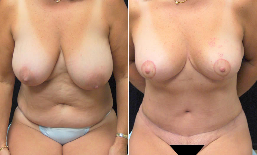 Before & After Tummy Tuck Front View 1