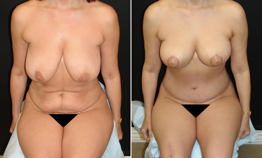 Before & After Tummy Tuck Front View