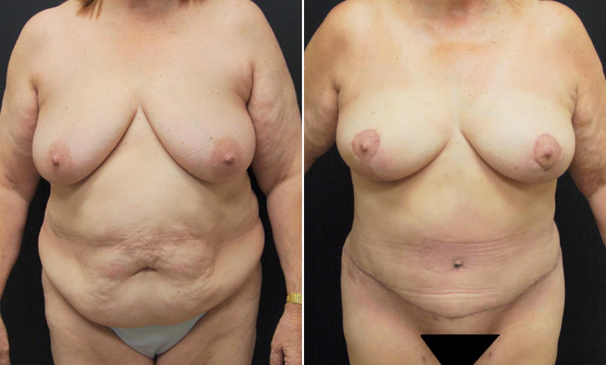 Before & After Tummy Tuck Front View