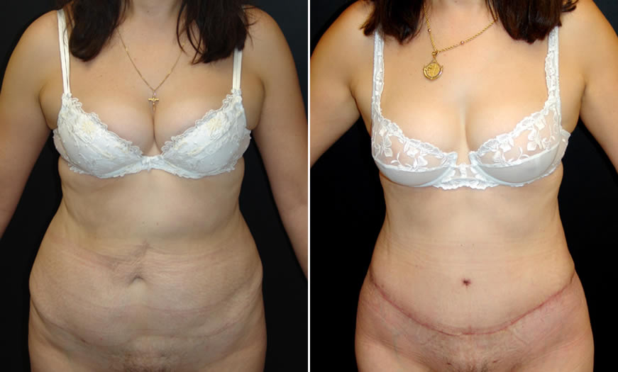 Before & After Tummy Tuck Front View