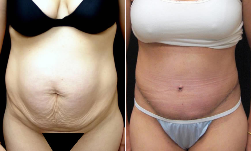 Before & After Tummy Tuck Front View